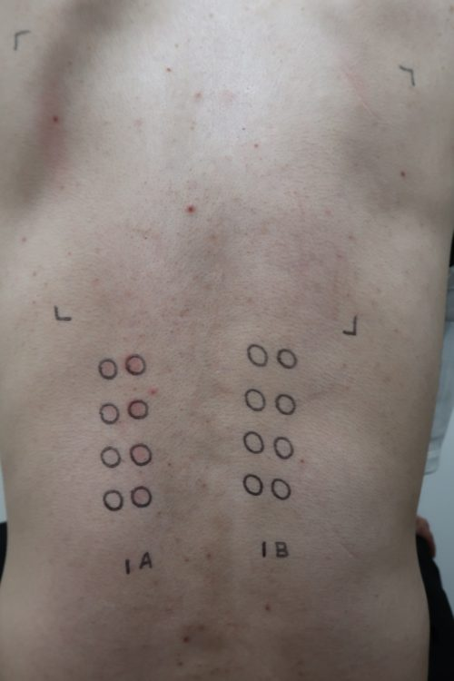 光線過敏症検査
