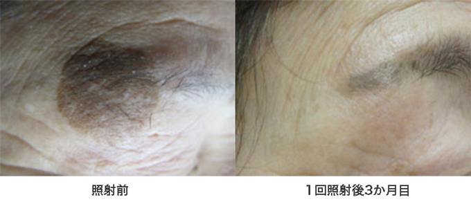 黒アザ・茶アザ治療