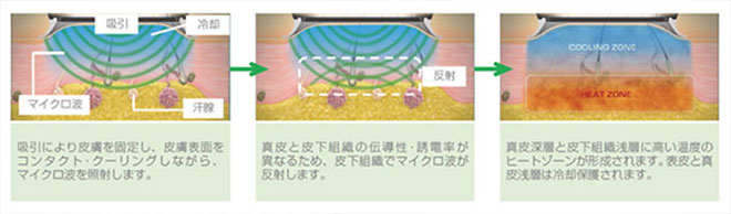 ミラドライによるワキ汗治療のメカニズム