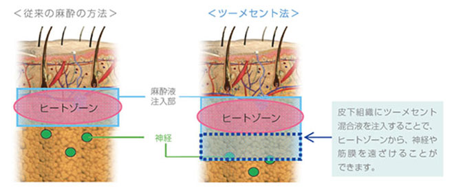 麻酔（安全性を高める新プロトコール）