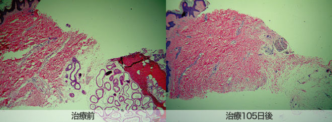 治療前 治療105日後