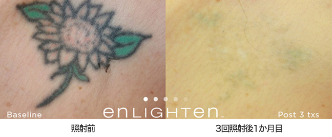 ピコレーザー治療