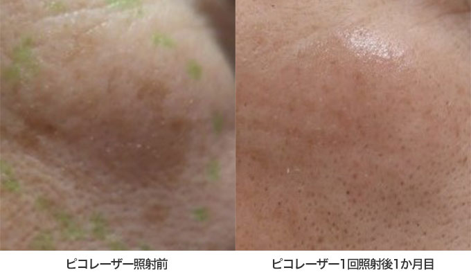 ピコレーザー治療