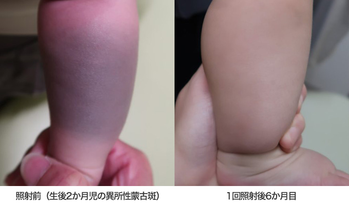 ピコレーザー治療