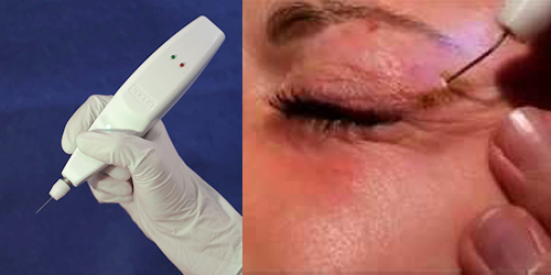 HIFUテクノロジーを搭載した、最新の痩身マシン：プラズマ・プレクサー