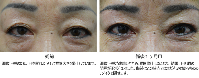 眼瞼下垂1