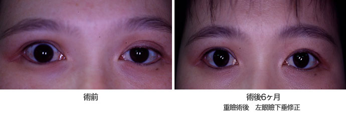 眼瞼下垂4